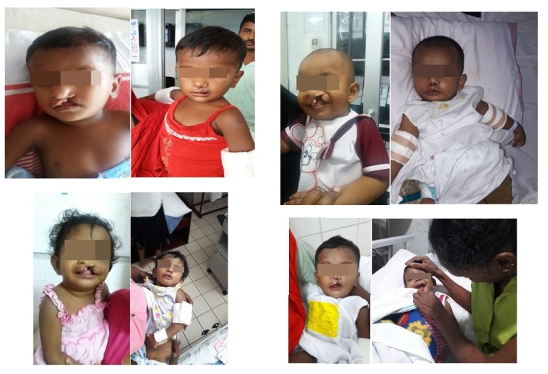 Gift Smile Project (Cleft Surgery)